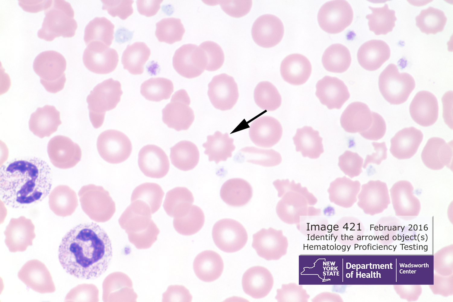 hematology PT image 421