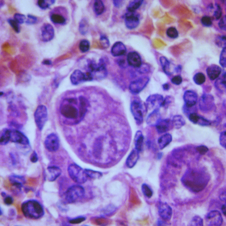 Cytomegalovirus in pituitary gland tissue magnified 500x. Photo credit: CDC
