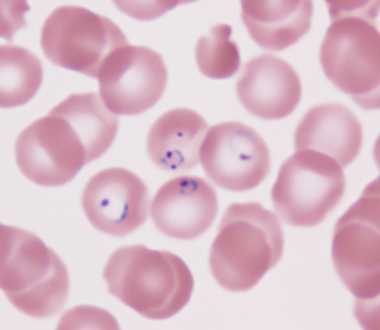 Ring form malaria parasites in red blood cells on a Giemsa-stained blood slide