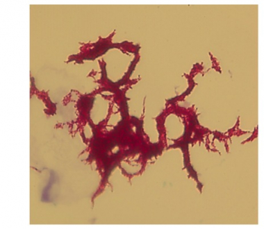 Corded TB acid fast stained by Ziehl-Neelsen method Corded TB acid fast stained by Ziehl-Neelsen method
