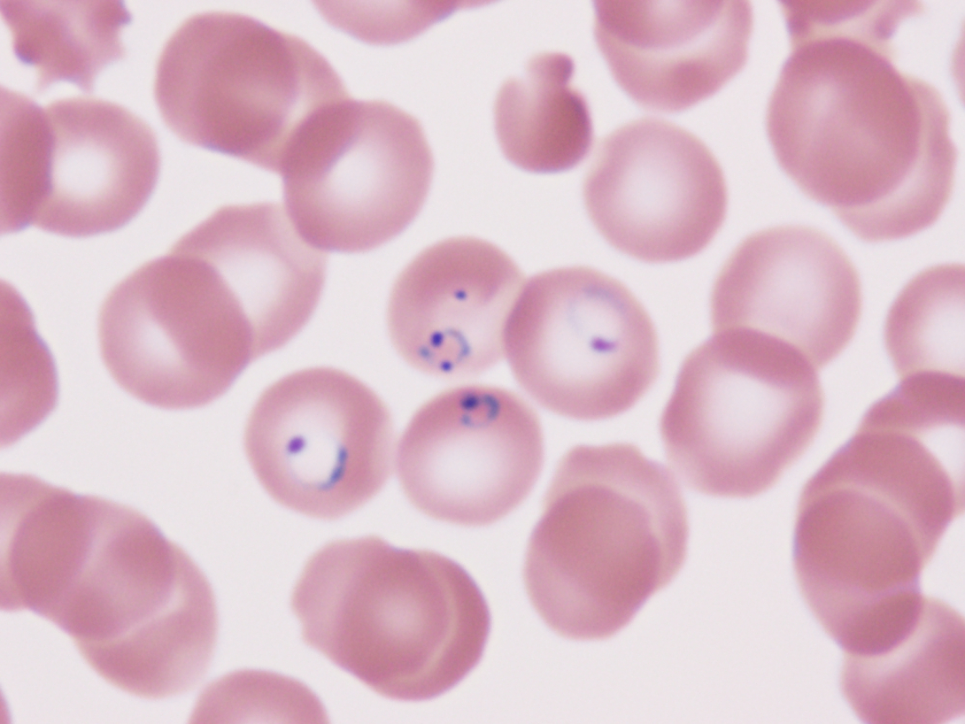 Ring form malaria parasites in red blood cells on a Giemsa-stained blood slide